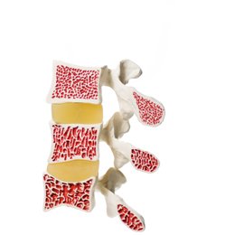 women's bone health
