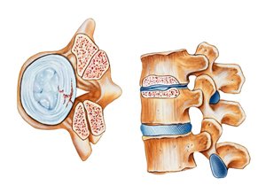 orthotic back brace