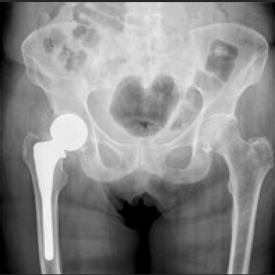 bones
